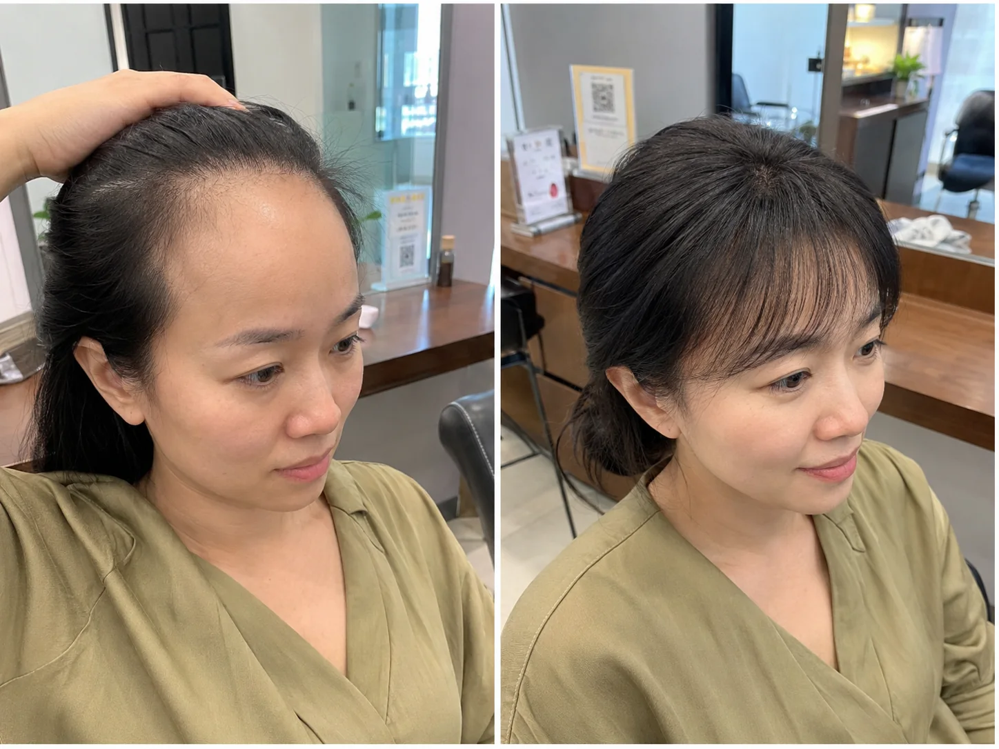 M&MY receding hairline solution before and after comparison showing a softer front hairline